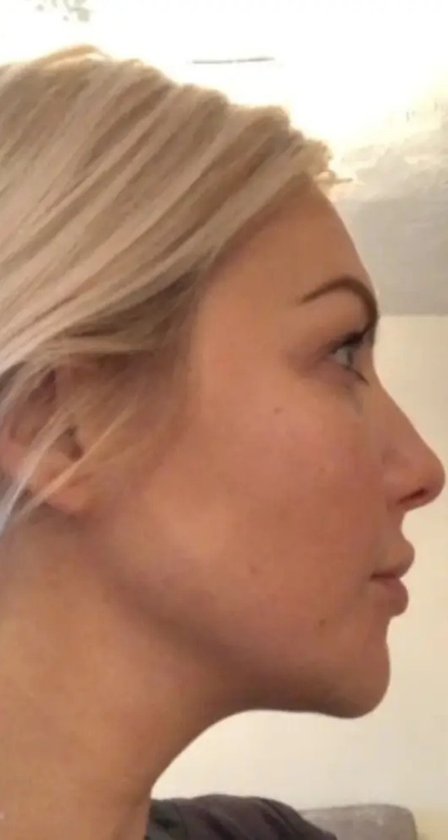 Client's chin and jawline after Aqualyx fat dissolving treatment at Portland Body Clinic