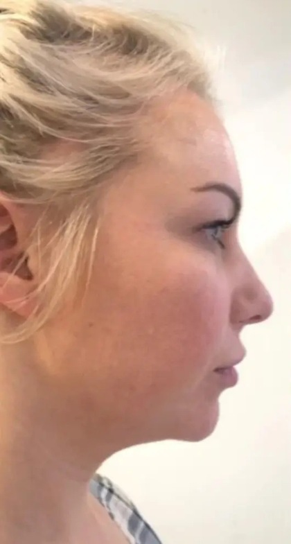 Aqualyx result at Portland Body Clinic — before