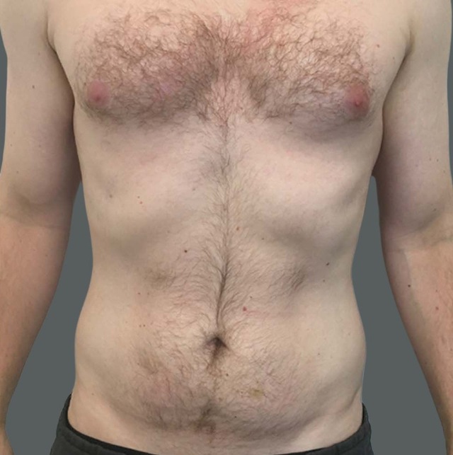 Client's lower stomach after Aqualyx fat dissolving treatment at Portland Body Clinic