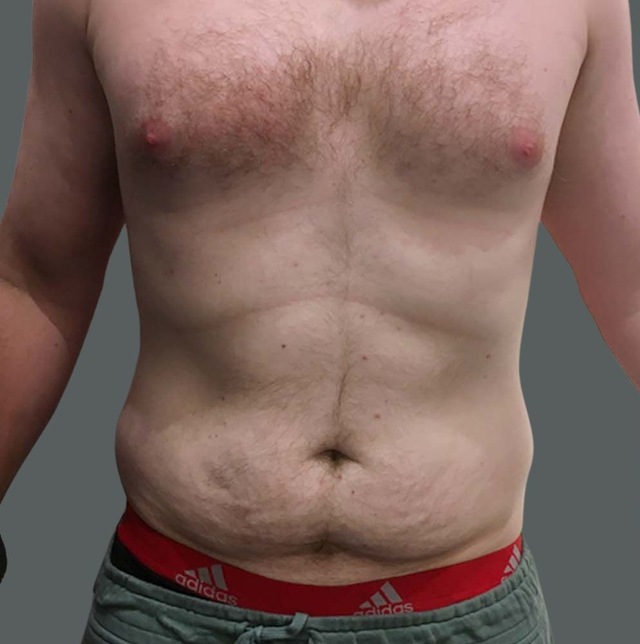 Client's lower stomach before Aqualyx fat dissolving treatment at Portland Body Clinic