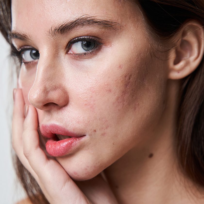 Client with acne scarring on the cheek at Portland Body Clinic Cardiff