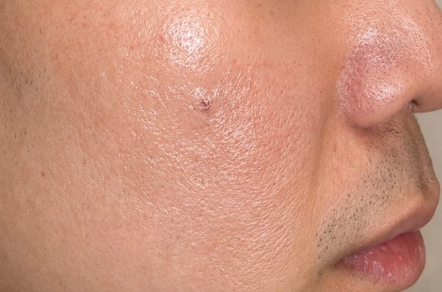 Client's cheek after DermaPro RF microneedling treatment at Portland Body Clinic