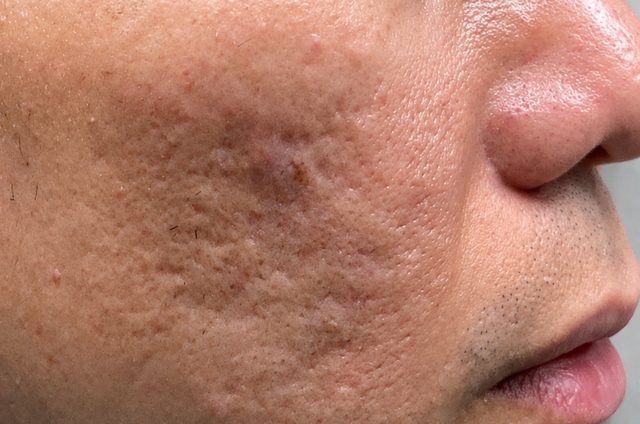 Client's cheek before DermaPro RF microneedling treatment at Portland Body Clinic