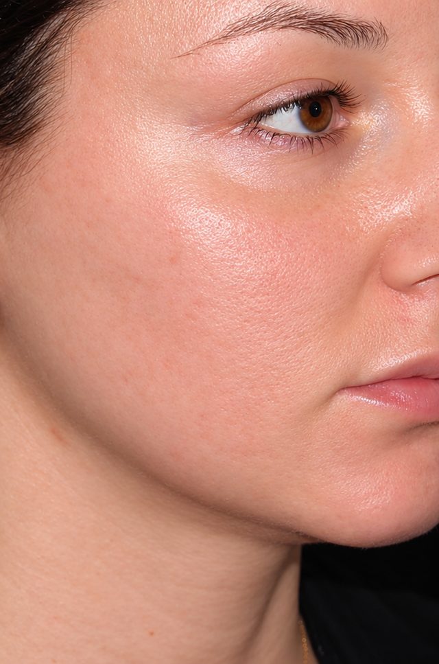 Client's cheek after Dermapen microneedling treatment at Portland Body Clinic