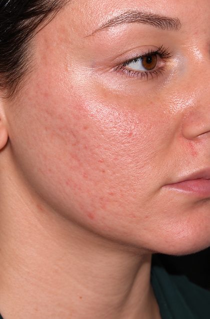 Acne Scar Treatment result at Portland Body Clinic — before