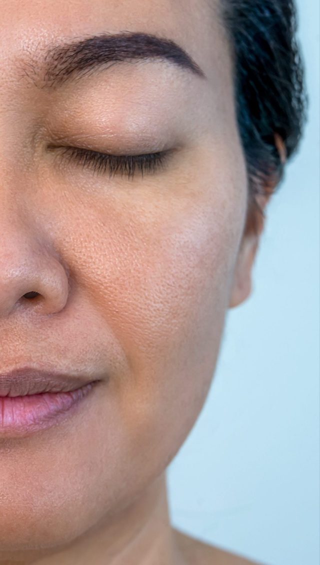 Client's face after chemical peel treatment at Portland Body Clinic