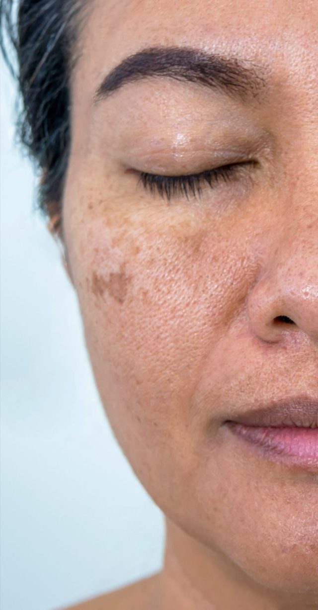 Client's face before chemical peel treatment at Portland Body Clinic