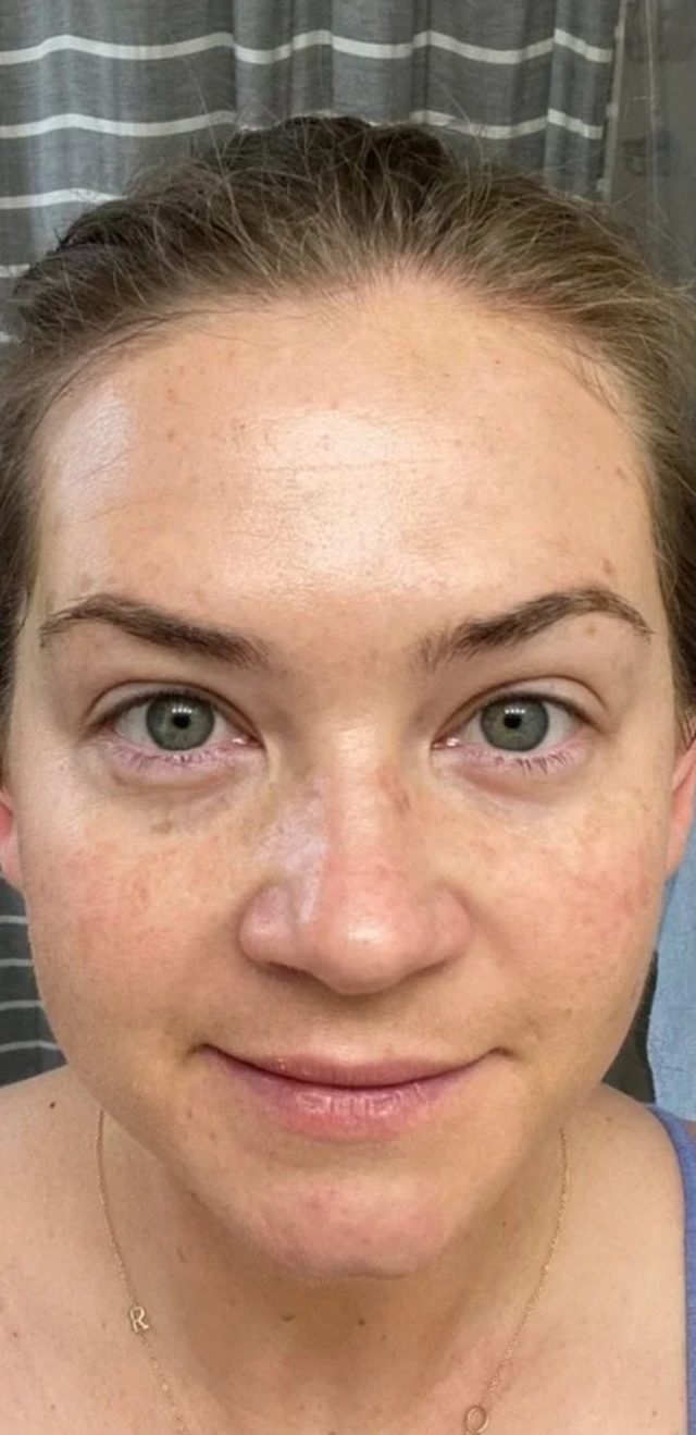Client's face after chemical peel treatment at Portland Body Clinic
