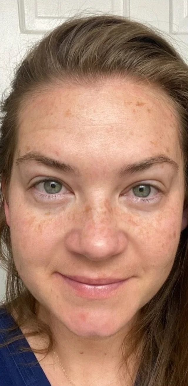 Client's face before chemical peel treatment at Portland Body Clinic