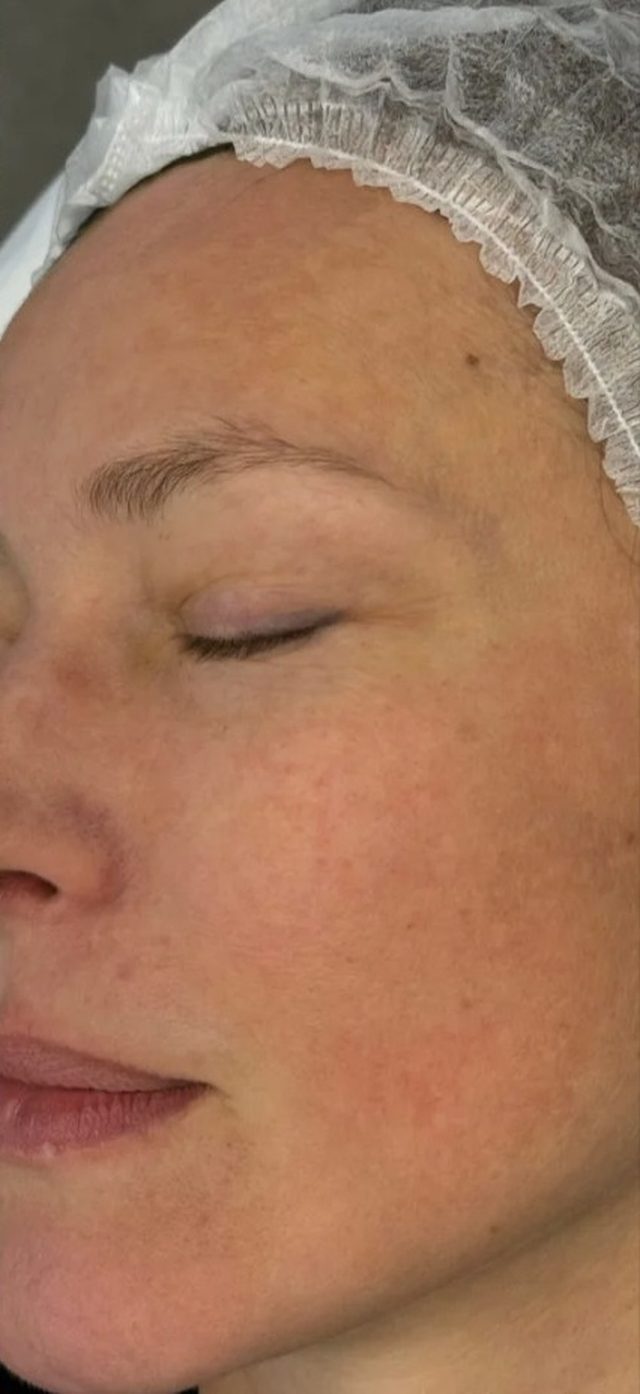 Client's face after Dermalux LED light therapy treatment at Portland Body Clinic