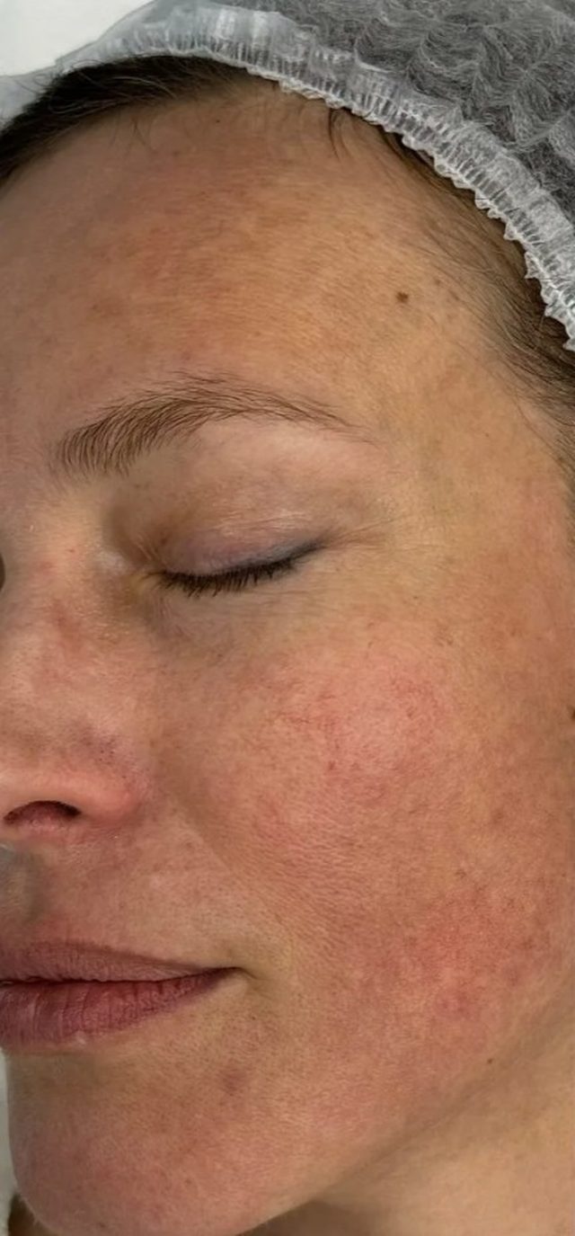 Client's face before Dermalux LED light therapy treatment at Portland Body Clinic