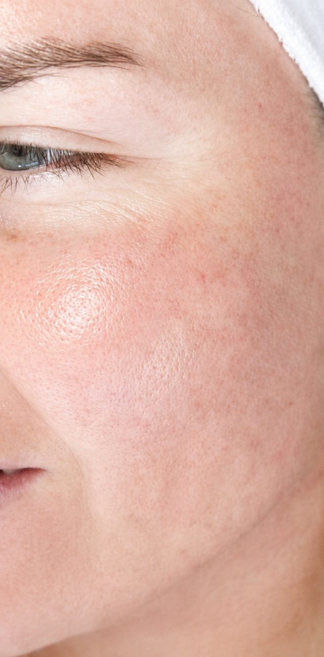Client's face after Dermalux LED light therapy treatment at Portland Body Clinic