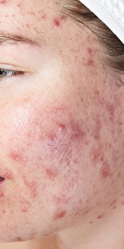 Dermalux LED result at Portland Body Clinic — before