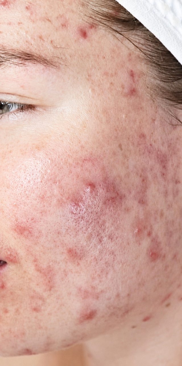 Client's face before Dermalux LED light therapy treatment at Portland Body Clinic