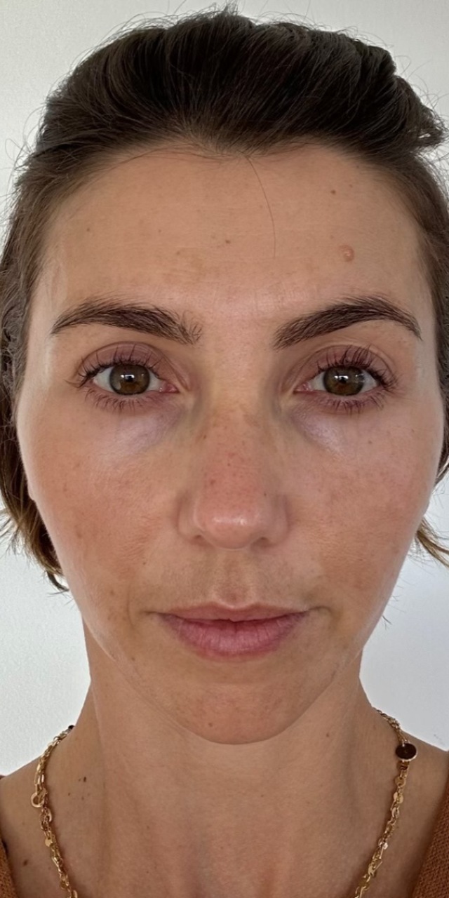 Client's face after Dermapen microneedling treatment at Portland Body Clinic