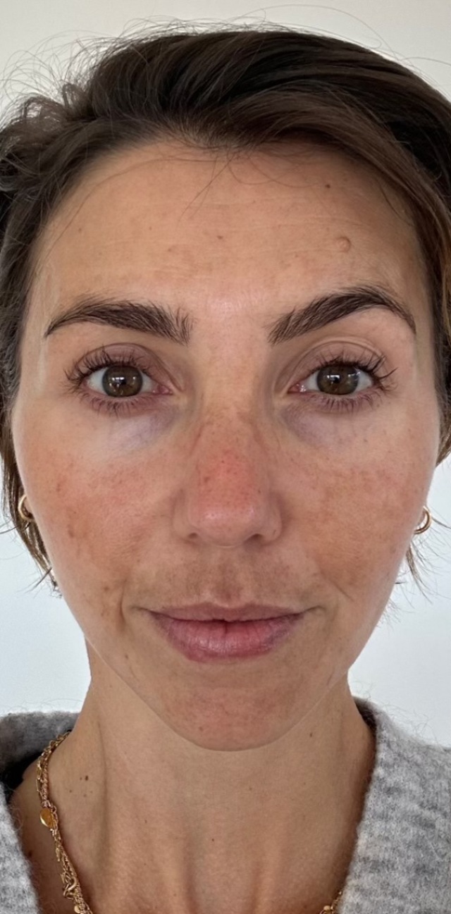 Client's face before Dermapen microneedling treatment at Portland Body Clinic
