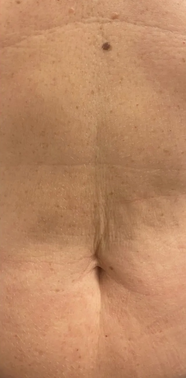 Client's abdomen after DermaPro RF microneedling treatment at Portland Body Clinic