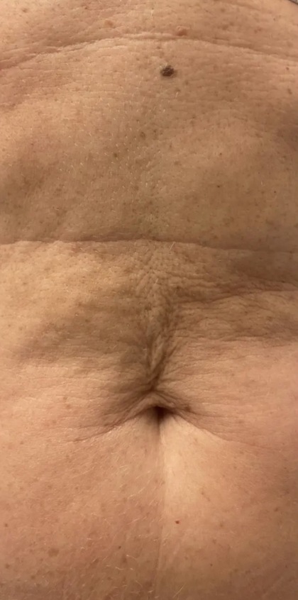DermaPro RF result at Portland Body Clinic — before