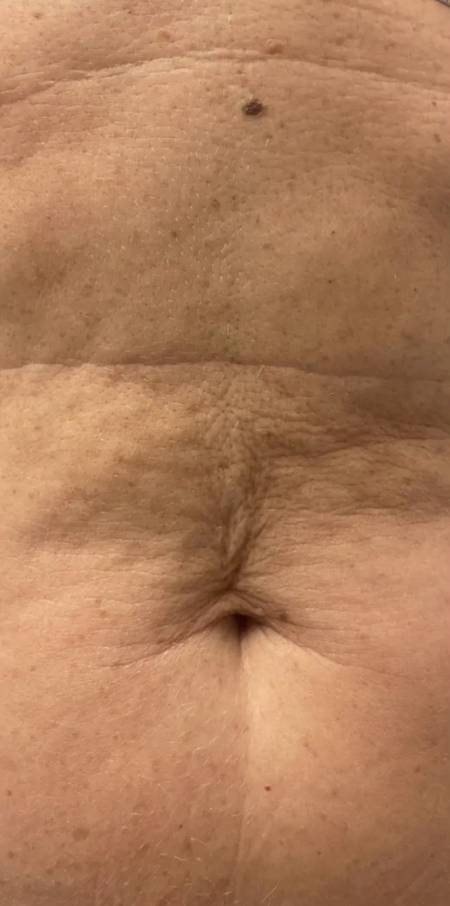 Client's abdomen before DermaPro RF microneedling treatment at Portland Body Clinic