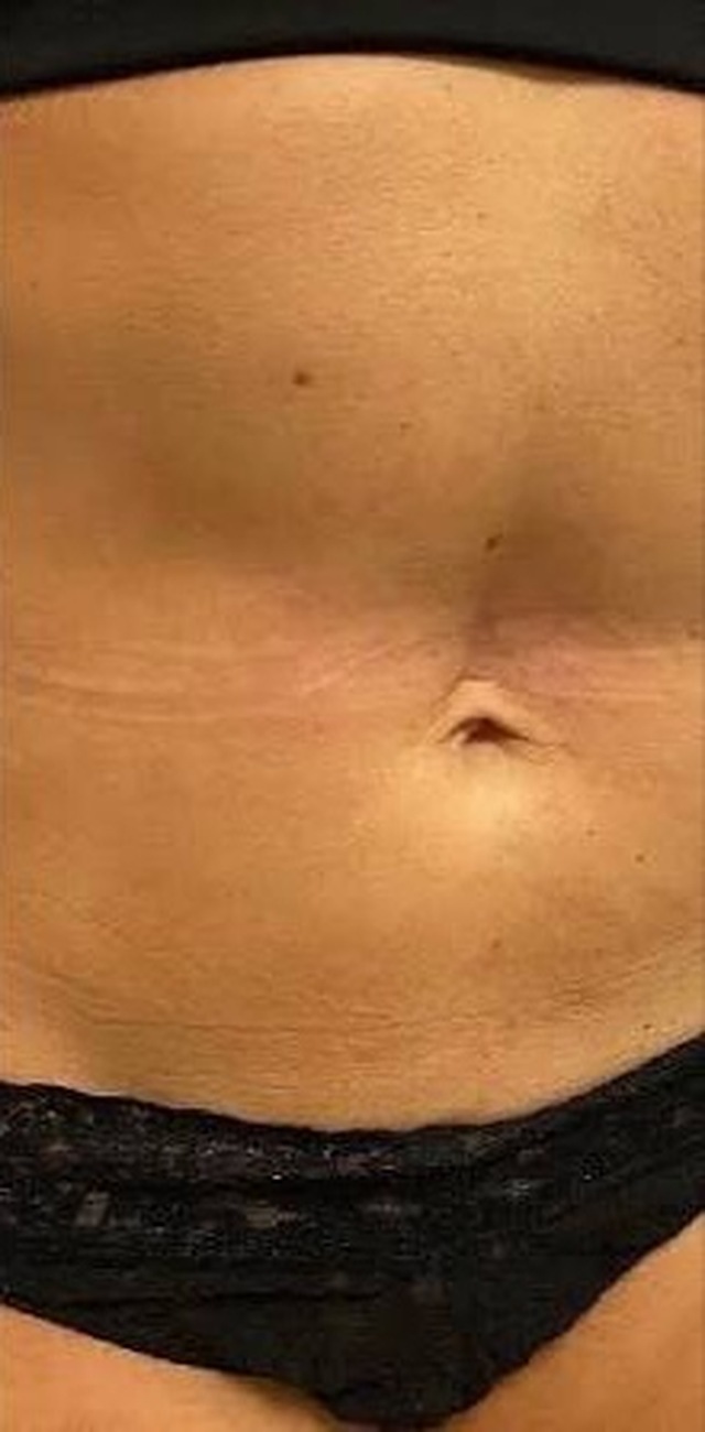 Client's abdomen after DermaPro RF microneedling treatment at Portland Body Clinic
