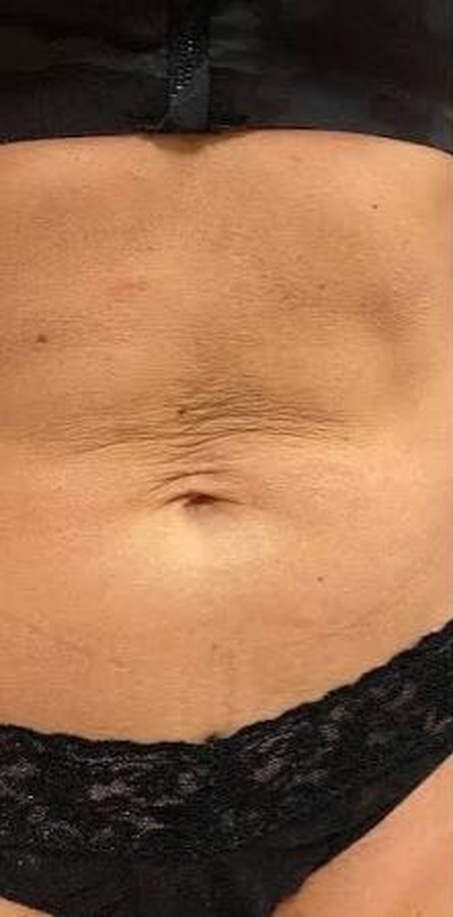 Client's abdomen before DermaPro RF microneedling treatment at Portland Body Clinic