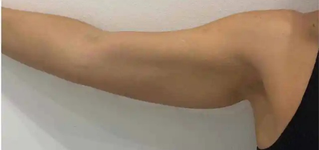 Client's arm after Aqualyx fat dissolving treatment at Portland Body Clinic