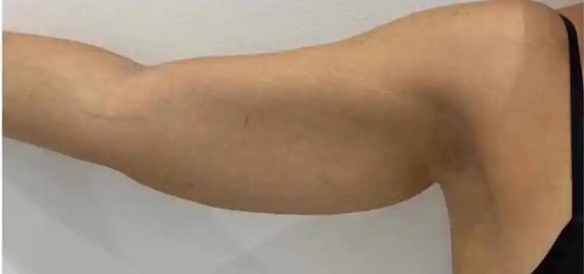 Client's arm before Aqualyx fat dissolving treatment at Portland Body Clinic