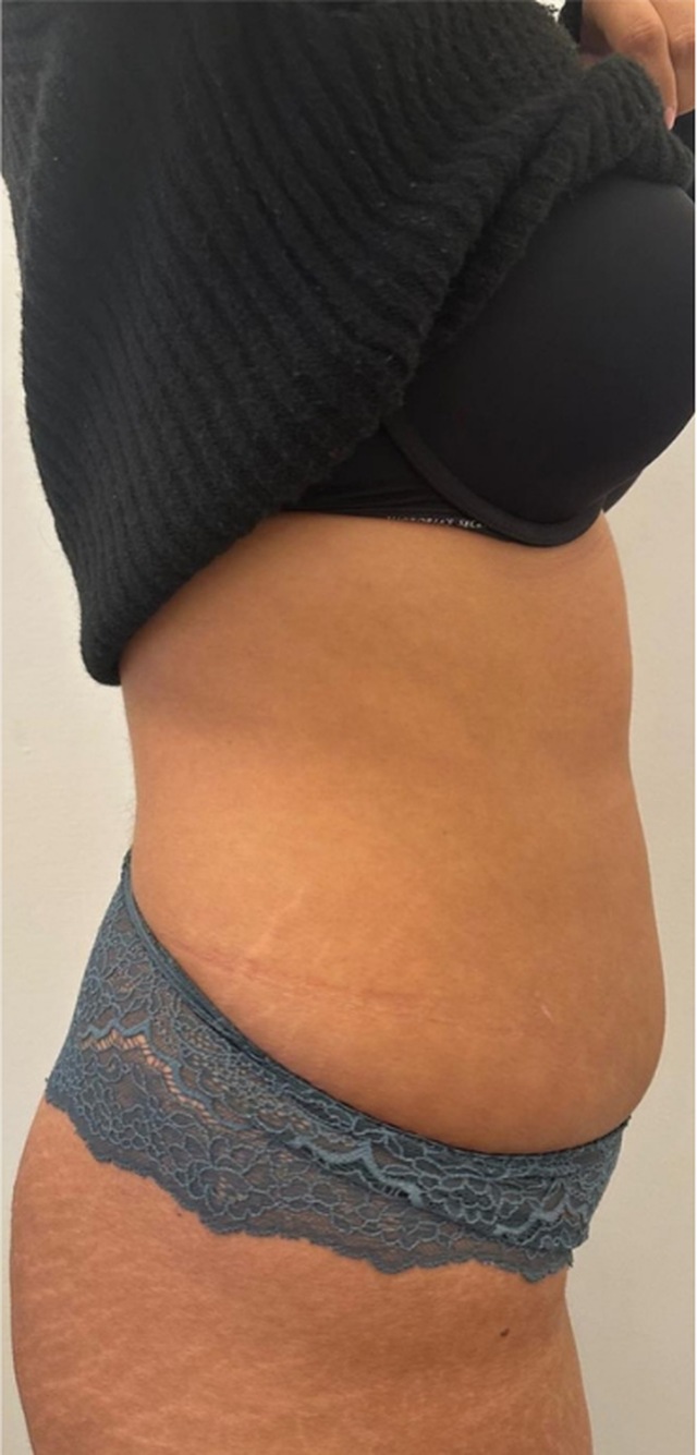 Client's lower stomach after Lemon Bottle fat dissolving treatment at Portland Body Clinic