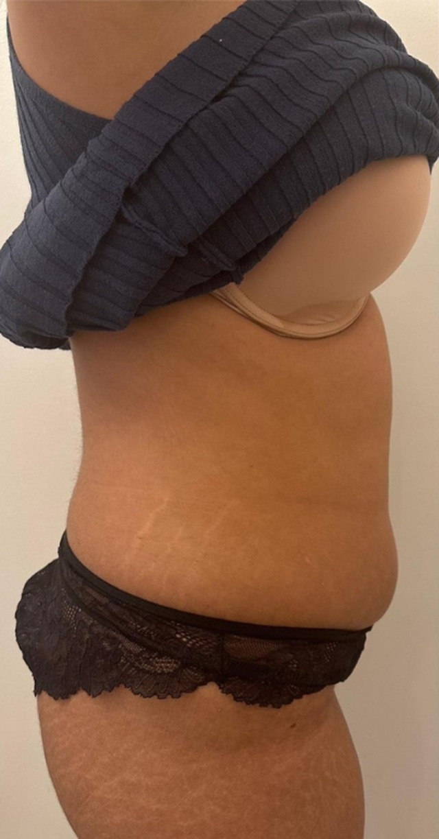 Client's lower stomach before Lemon Bottle fat dissolving treatment at Portland Body Clinic