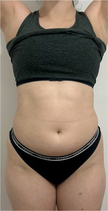 360 Fat Freezing result at Portland Body Clinic — before