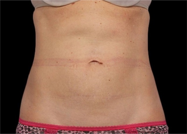 Client's abdomen after 360 degree Fat Freezing treatment at Portland Body Clinic