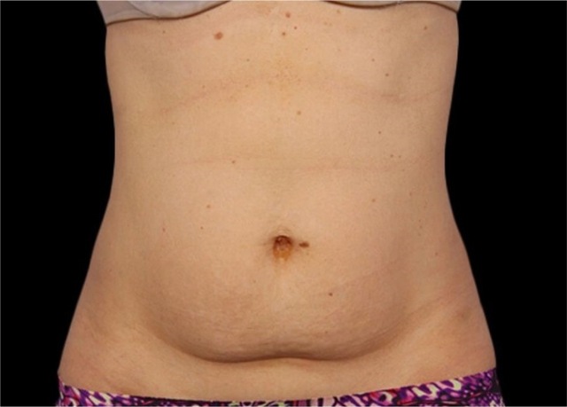 Client's abdomen before 360 degree Fat Freezing treatment at Portland Body Clinic