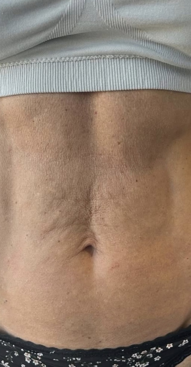 Client's abdomen after HIFU skin tightening treatment at Portland Body Clinic