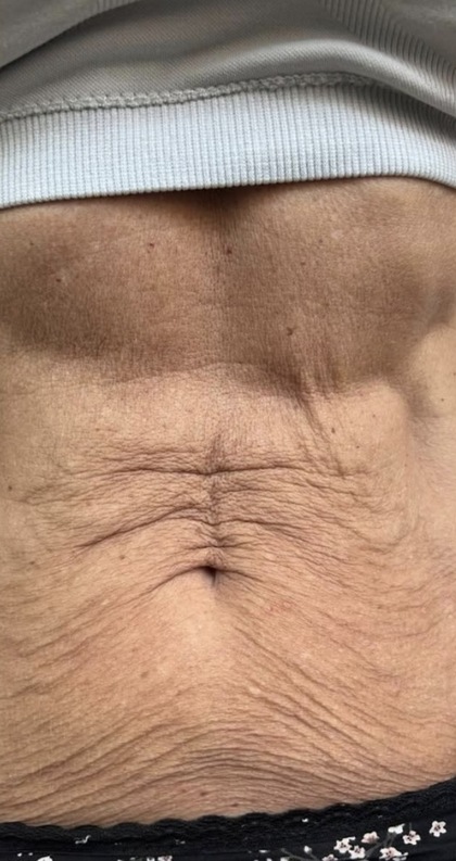 HIFU result at Portland Body Clinic — before