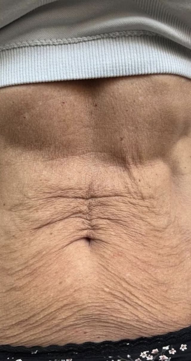 Client's abdomen before HIFU skin tightening treatment at Portland Body Clinic