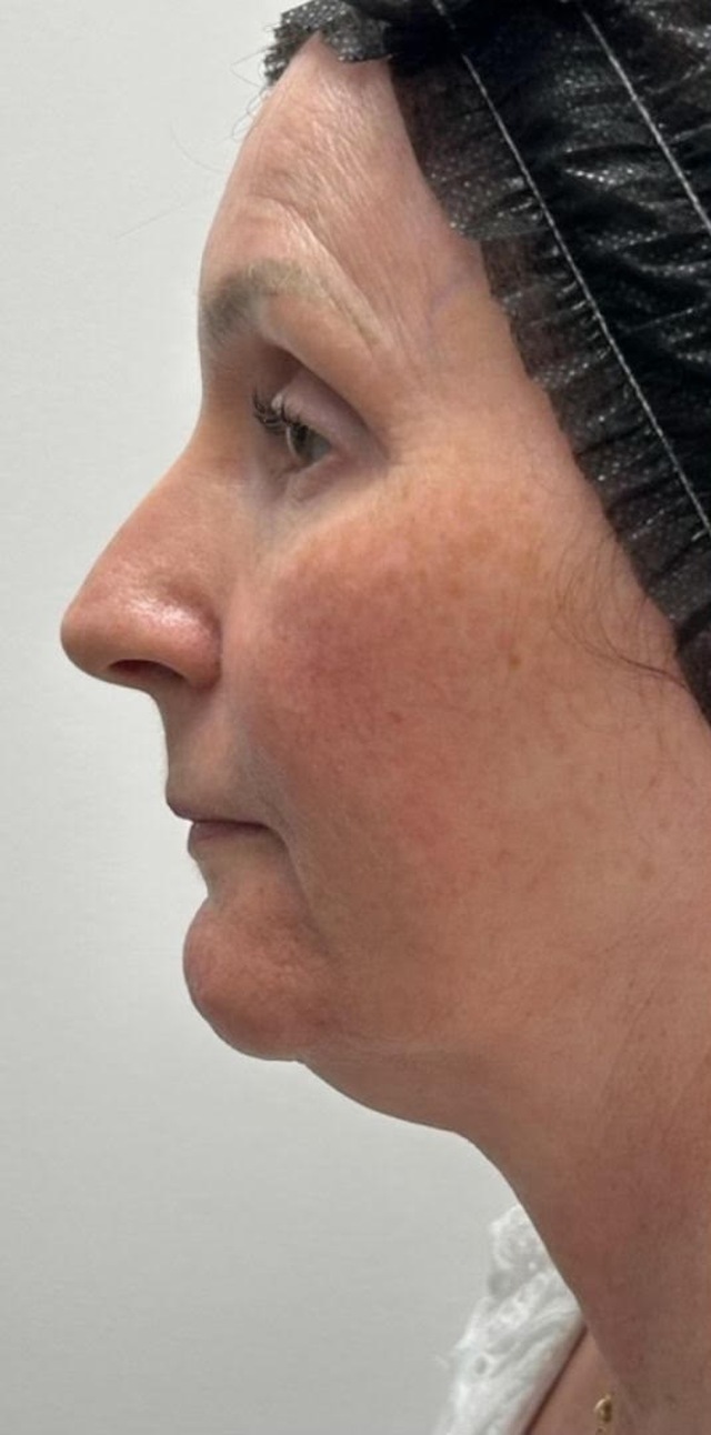 Client's face and jawline after HIFU skin tightening treatment at Portland Body Clinic