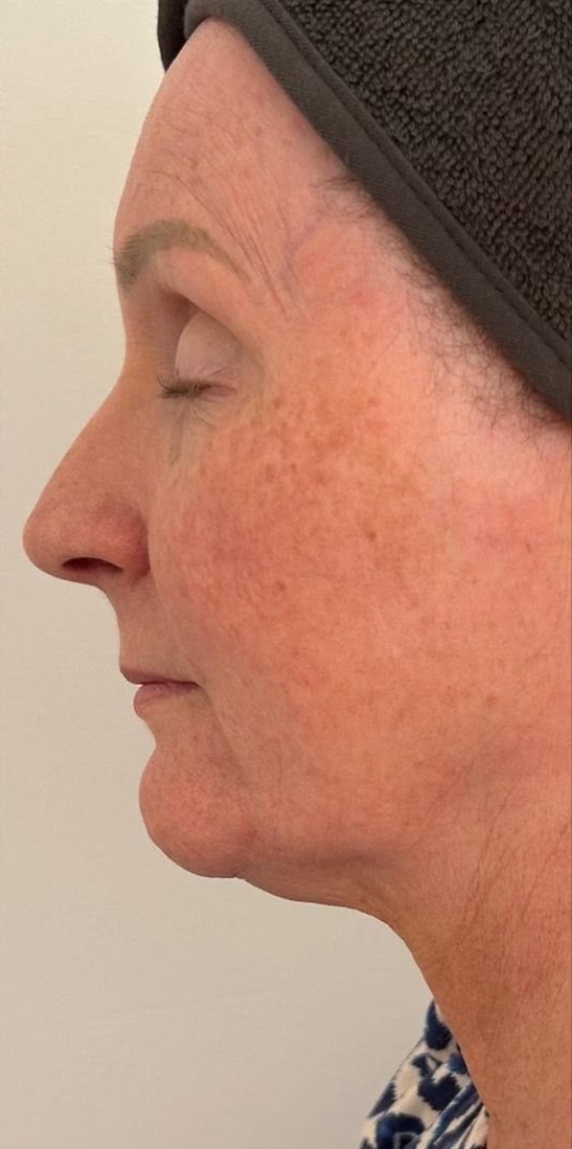 Client's face and jawline before HIFU skin tightening treatment at Portland Body Clinic