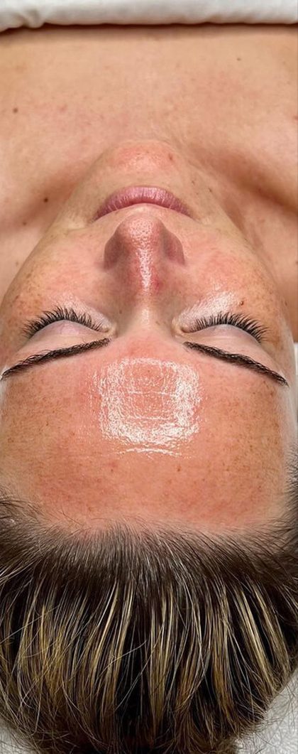 Client's forehead after Hydrofacial treatment at Portland Body Clinic
