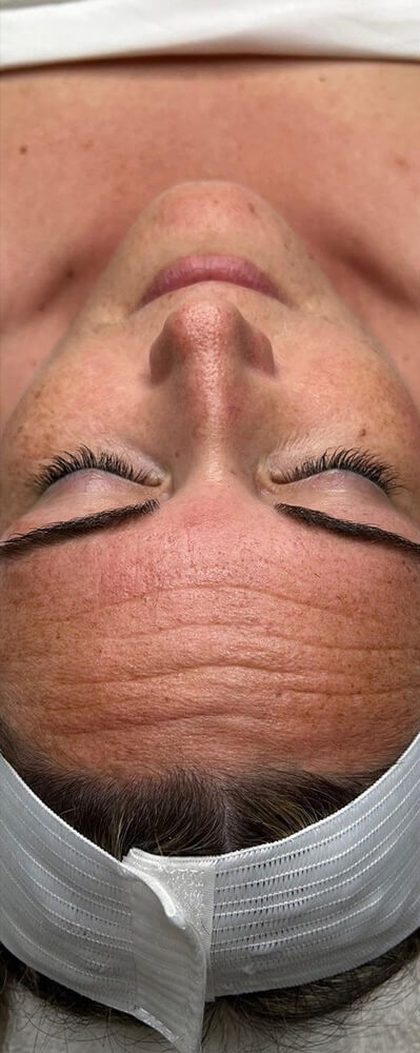 Client's forehead before Hydrofacial treatment at Portland Body Clinic