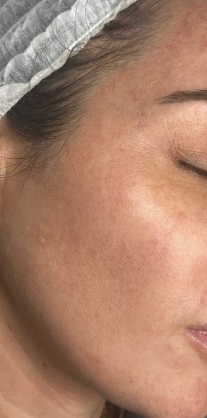 Hydrofacial result at Portland Body Clinic — before