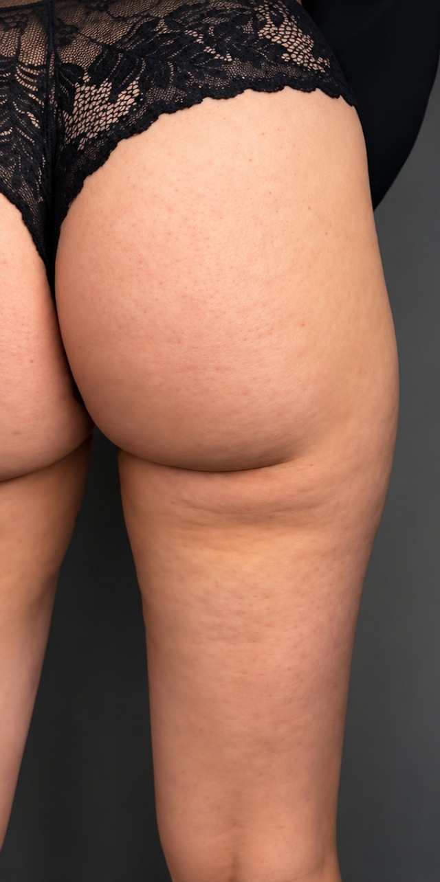 Client's glute contour before Kim K Curves contouring treatment at Portland Body Clinic