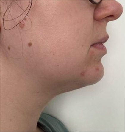 Lemon Bottle result at Portland Body Clinic — before