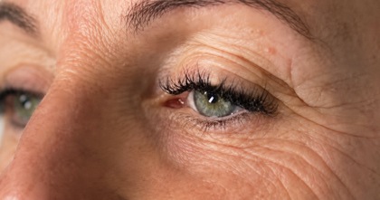 Lumi-PN Eyes result at Portland Body Clinic — before