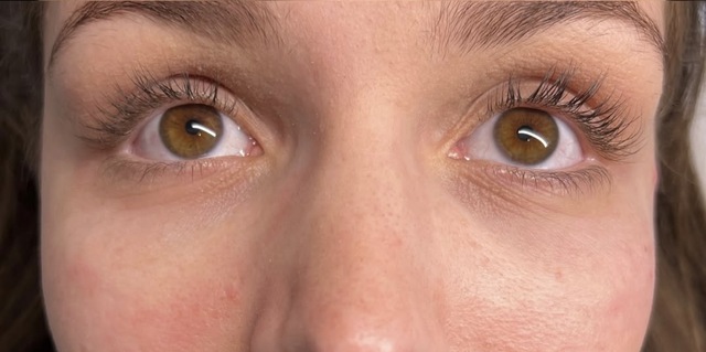 Client's under-eye area after Lumi-PN Eyes treatment at Portland Body Clinic