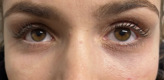 Client's under-eye area before Lumi-PN Eyes treatment at Portland Body Clinic