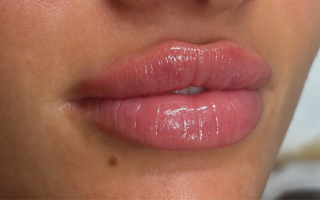 Client's lips after LUMI-PRO Lips treatment at Portland Body Clinic