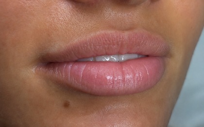 LUMI-PRO Lips result at Portland Body Clinic — before