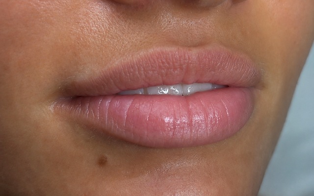Client's lips before LUMI-PRO Lips treatment at Portland Body Clinic