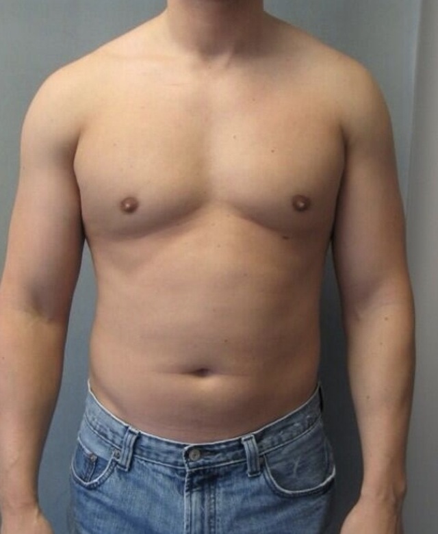 Client's male chest after Aqualyx treatment at Portland Body Clinic
