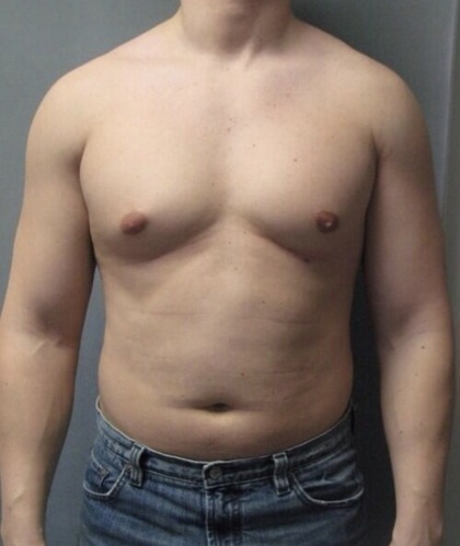 Male Chest Reduction result at Portland Body Clinic — before